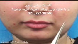 لاغر کردن صورت افزایش زیبایی تخلیه چربی ناحیه بوکال