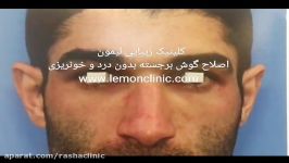 اصلاح گوش های تا حدودی برجسته تغییر فرم در لاله گوش