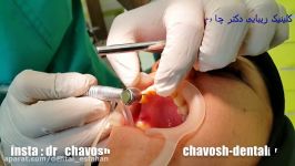 عصب کشی دندانی عفونت کرده عصب کشی ترمیم ریشه تخصصی دندان در اصفهان