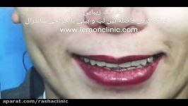 کاهش فاصله لب تا بینی انجام جراحی سانترال