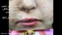 اصلاح جای زخم در فاصله بین بینی تا انتهای لب بالا جراحی میکروسکوپی