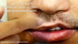 جراحی زیبایی لب شکری در معتبرترین مرکز جراحی لب تهران