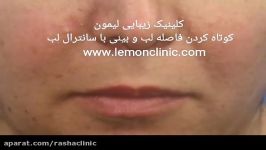 زیباسازی جوان سازی صورت انجام جراحی لیفت سانترال لب