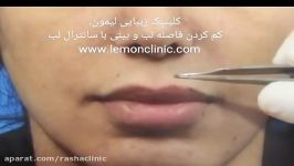 زیباسازی صورت کاهش فاصله لب تا بینی جراحی لیفت سانترال لب