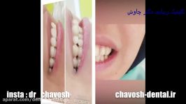 کلینیک دندانپزشکی زیبایی چاوش در اصفهان ، لمینت ، کاموزیت ، ایمپلنت ، بلیچینگ
