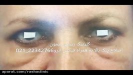 اصلاح پلک بالا افزایش فاصله ابرو تا چشم بشکل طبیعی