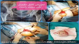 جراحی تعویض کامل مفصل لگن سمت راست توسط دکتر امین جواهری