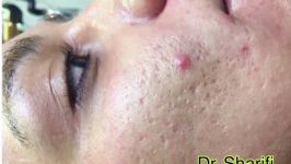 remove acne scar رفع بهبود جاى جوش