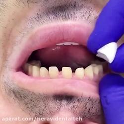 چگونگی نصب روکش دندان برای دندان های بالا ردیف جلو