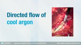 Argon Beam Coagulation ABC for Total Joint Procedures  ConMed Product Video