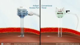 AirSeal® System  CONMED Product Video