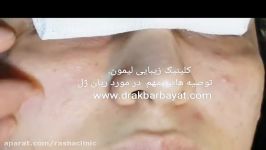 تغییر فرم ایجاد غیرقرینگی صورت بعد تزریق ژل نامعتبر ریان