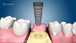 ایمپلنت دندان یا ایمپلنتولوژی چیست؟