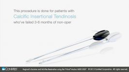 Haglunds Excision and Achilles Reconstruction using Y Knot® Anchor