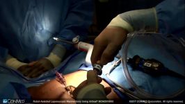 Dr. Arnold Advincula  Robotic Laparoscopic Myomectomy Using AirSeal