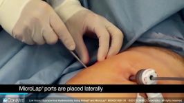 Dr. Peter Rosenblatt  Low Impact Supracervical Hysterectomy Using AirSeal