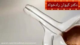 برداشتن تومور مثانه