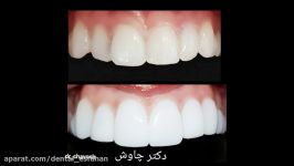 10 واحد کامپوزیت ونیر دندان در اصفهان