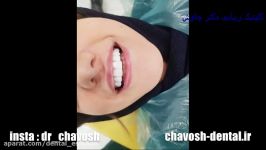 پالیش نهایی 10 واحد کامپوزیت ونیر دندان در اصفهان  دندانپزشکی زیبایی دکتر چاوش