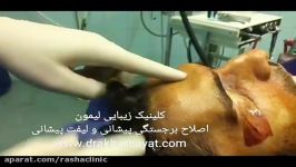 لیفت اصلاح برجستگی پیشانی در معتبرترین مرکز جراحی سر گردن در تهران