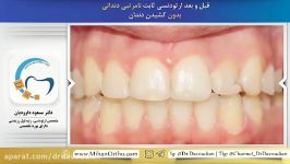 ارتودنسی ثابت بدون کشیدن دندان  دکتر مسعود داودیان