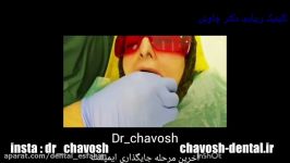 کاشت چسباندن روکش 5 واحد ایمپلنت دندان در اصفهان  دندانپزشکی زیبایی چاوش