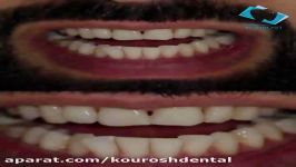 عکس قبل بعد کامپوزیت دندان  ویدیو کامپوزیت دندان در مشهد  کلینیک کوروش