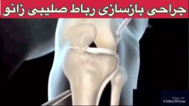 جراحی رباط صلیبی زانو09122655648پزشک متخصص ارتوپد،فیزیوتراپی در تهران،قم