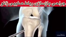 جراحی رباط صلیبی زانو09122655648دکتر متخصص ارتوپدی،فیزیوتراپی در مطب،منزل تهران