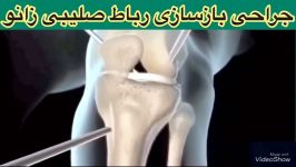 جراحی رباط صلیبی زانو09122655648متخصص ارتوپدی،کاردرمانی،فیزیوتراپی در تهران