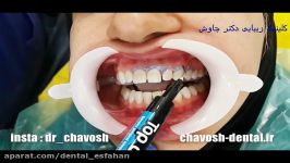آفیس بلیچینگ مطب دندان در اصفهان  سفید کردن دندان در مطب اصفهان