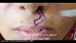 اسکار ترمیم زخم صورت