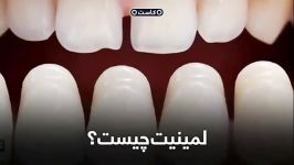 چهار نکته اساسی در مورد لمینت، لازم است بدانید