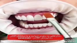 بلیچینگ دندان  سفید کردن دندان  جرمگیری بروساژ دندان