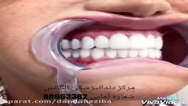 پست های زیبایی دندان  روکش دندان  بریج دندان  کامپوزیت دندان