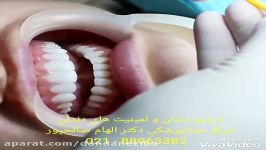 سفید کردن دندان  بلیچینگ دندان  کامپوزیت دندان  روکش دندان