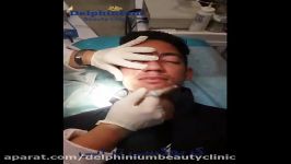 کربوکسی تراپی  delphiniumbeautyclinic