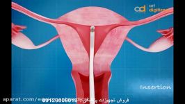 نحوه قرار دارد تعویض آی یو دی   iud