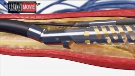 Cholesterol and Blood Clot Removal Systems