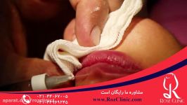 تزریق ژل  فیلم تزریق ژل  کلینیک پوست مو رز  شماره 11