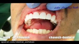 مراحل انجام 8 واحد کامپوزیت ونیر دندان در اصفهان  کلینیک دندانپزشکی چاوش اصفهان