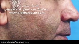 زیباسازی چهره کم کردن فاصله لب تا بینی اصلاح پره های بینی