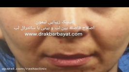 زیباسازی چهره ایجاد تناسب در فاصله بین لب تا بینی