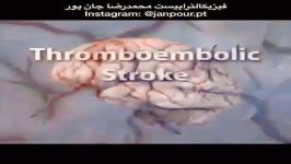 درمان پزشکی سکته مغزی فیزیوتراپی09122655648مرکز ارتوپدی فنی،کفش،کفی طبی در تهران