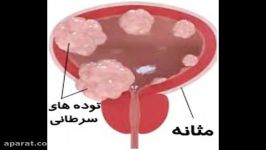 درمان تومور مثانه تنها مصرف 1دوره داروی طب اسلامی