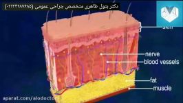 الو دکتر لیپوماتیک سایر روش های کشیدن چربی