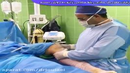 بازسازی رباط صلیبی زانو به روش بسته