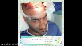 زراعة الشعر فی ایران مع مرکز التجمیل طب ماهان بمشهد