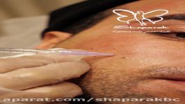 مزوتراپی صورت برای آقایان در کلینیک تخصصی پوست مو شاپرک