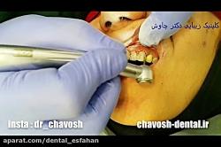 تعویض کامپوزیت قدیمی دندان کامپوزیت جدید  کامپوزیت دندان در اصفهان